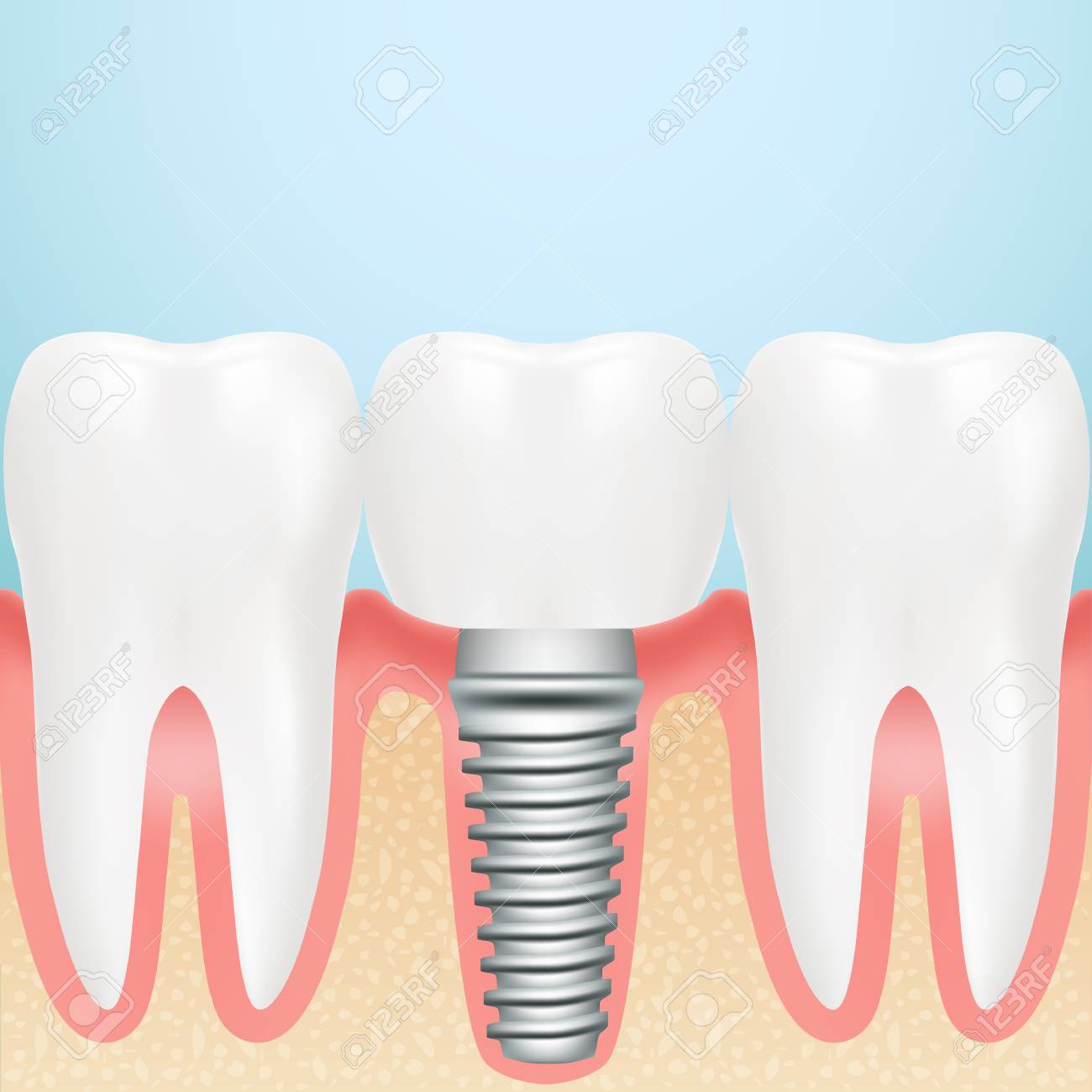 Realistic Dental Implant. Installation Of Dental Implant With All Parts Crown, Abutment, Screw Isolated On A Background. Vector Illustration.