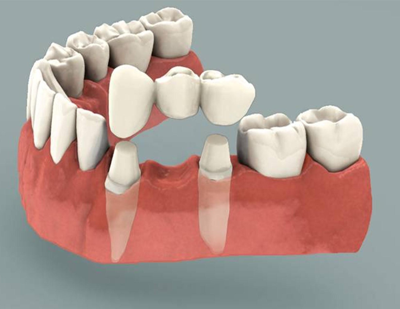 dental-bridge-basic-info