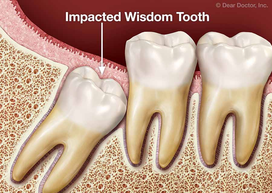 impacted-wisdom-tooth